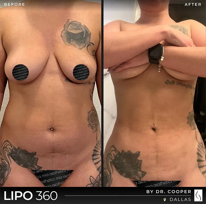 Dr. Cooper • Lipo 360 • image 4