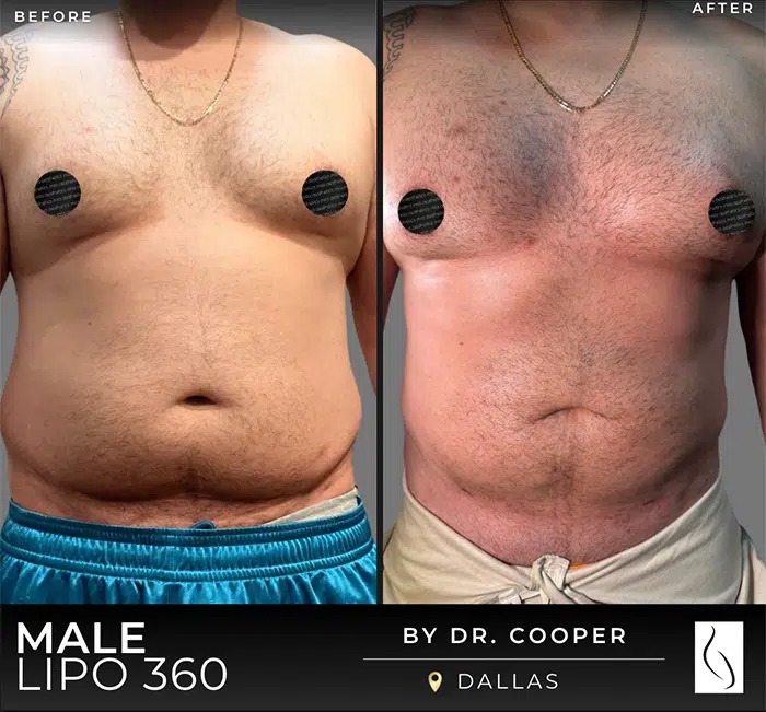 Dr. Cooper • Lipo 360 • image 5