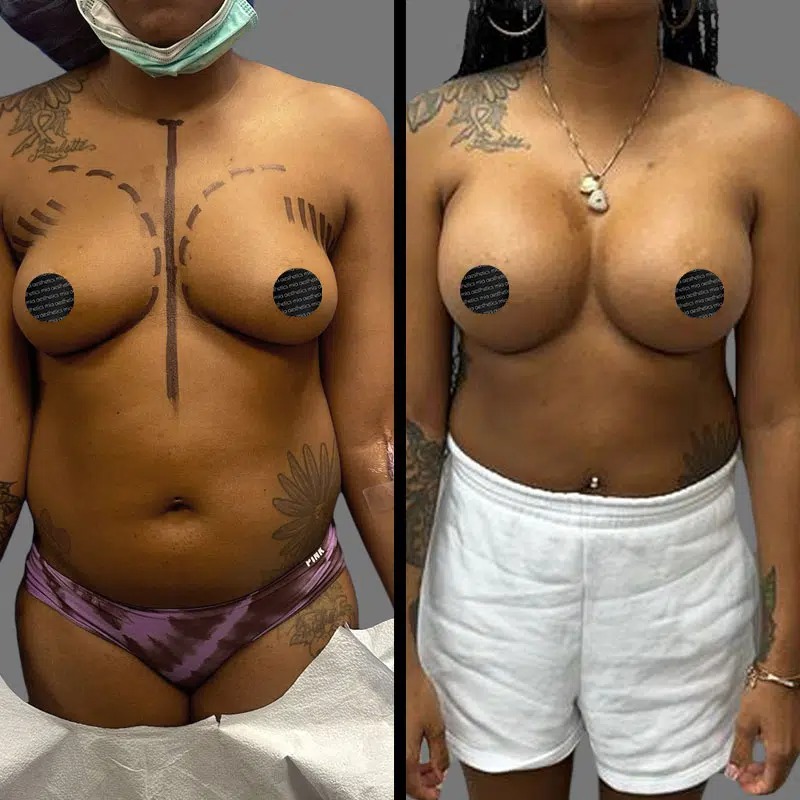 Dr. Fasusi • Breast Procedures • image 2