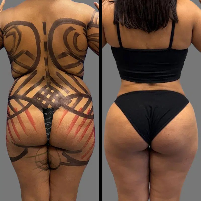 Dr. Fasusi • Brazilian Butt Lift (BBL) • image 1