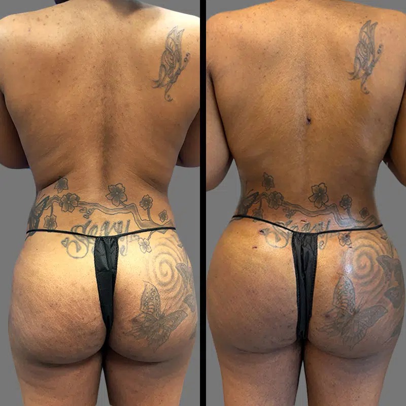 Dr. Fasusi • Brazilian Butt Lift (BBL) • image 3