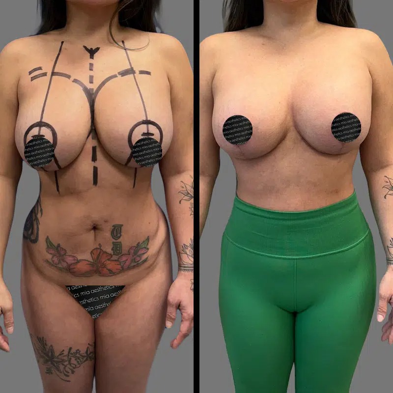 Dr. Fasusi • Breast Procedures • image 3