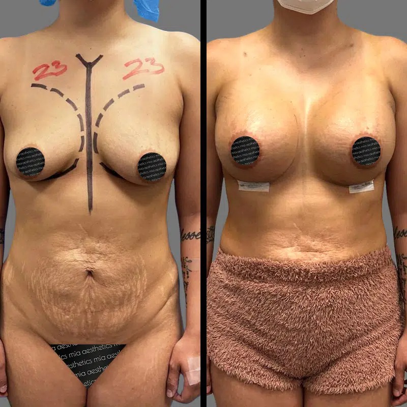 Dr. Fasusi • Breast Procedures • image 4