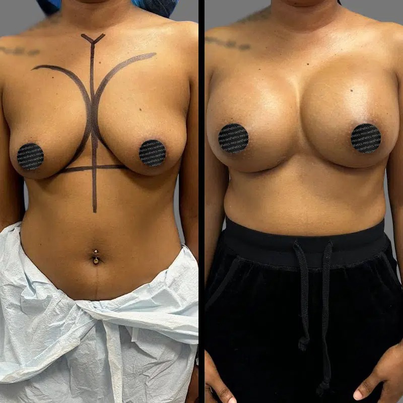 Dr. Fasusi • Breast Procedures • image 5