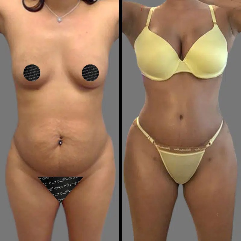 Dr. Fasusi • Mommy Makeover • image 4