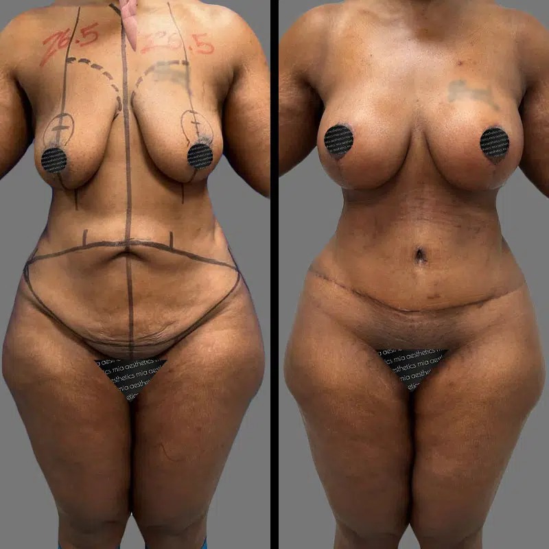 Dr. Fasusi • Mommy Makeover • image 5