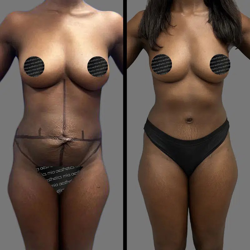 Dr. Fasusi • Tummy Tuck • image 1