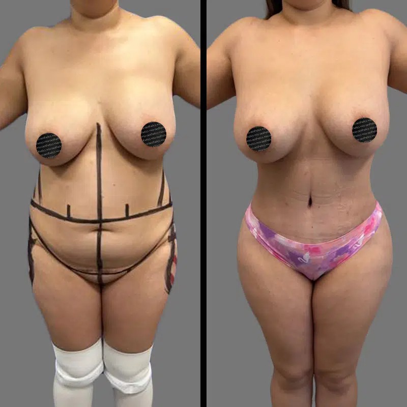 Dr. Fasusi • Tummy Tuck • image 2