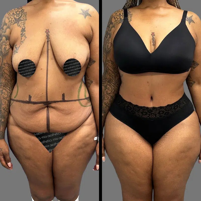 Dr. Fasusi • Tummy Tuck • image 3