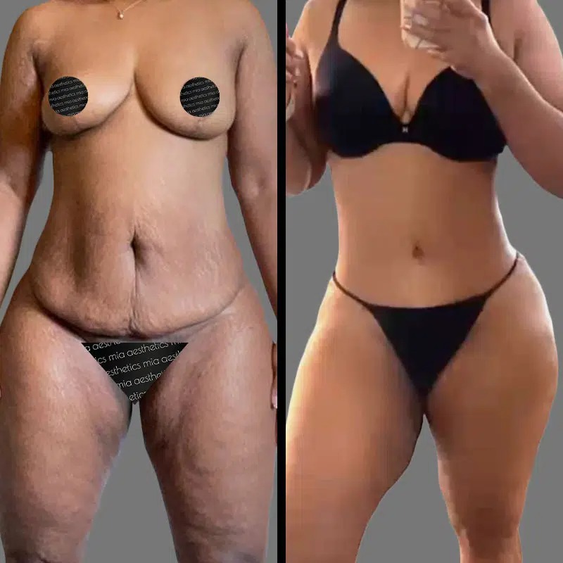 Dr. Fasusi • Tummy Tuck • image 5