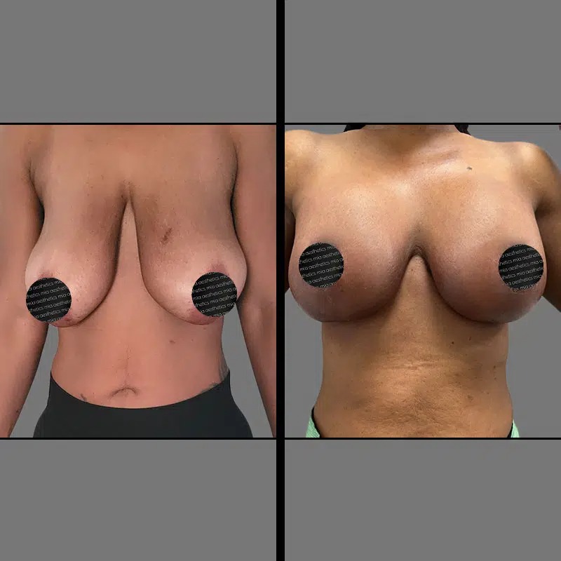 Dr. Giorgis • Breast Procedures • image 4