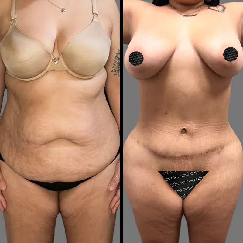 Dr. Giorgis • Tummy Tuck • image 1