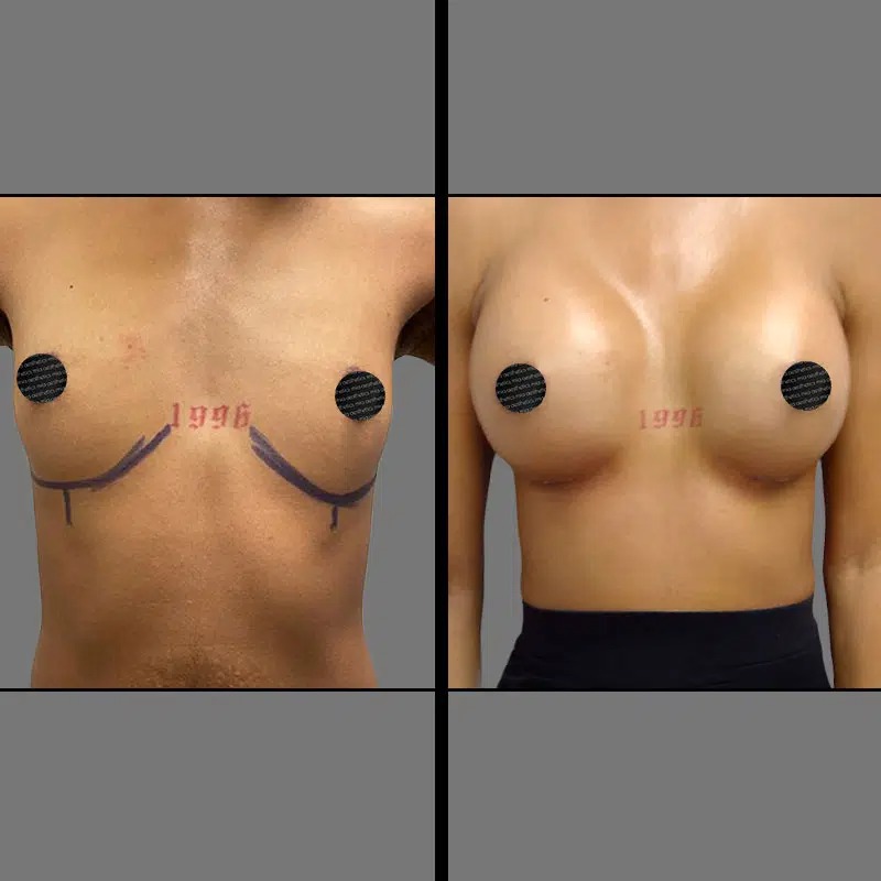 Dr. Gray • Breast Procedures • image 2