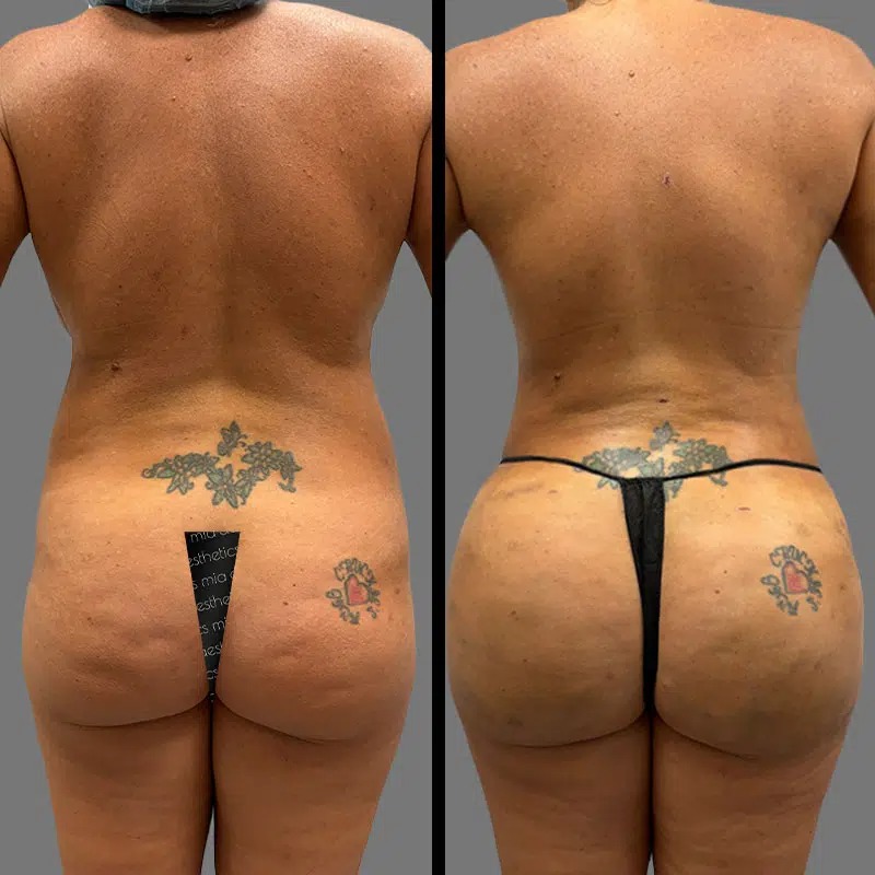Dr. Gray • Brazilian Butt Lift (BBL) • image 2