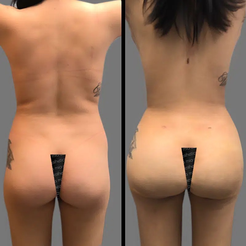 Dr. Gray • Brazilian Butt Lift (BBL) • image 3