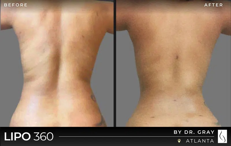 Dr. Gray • Lipo 360 • image 1