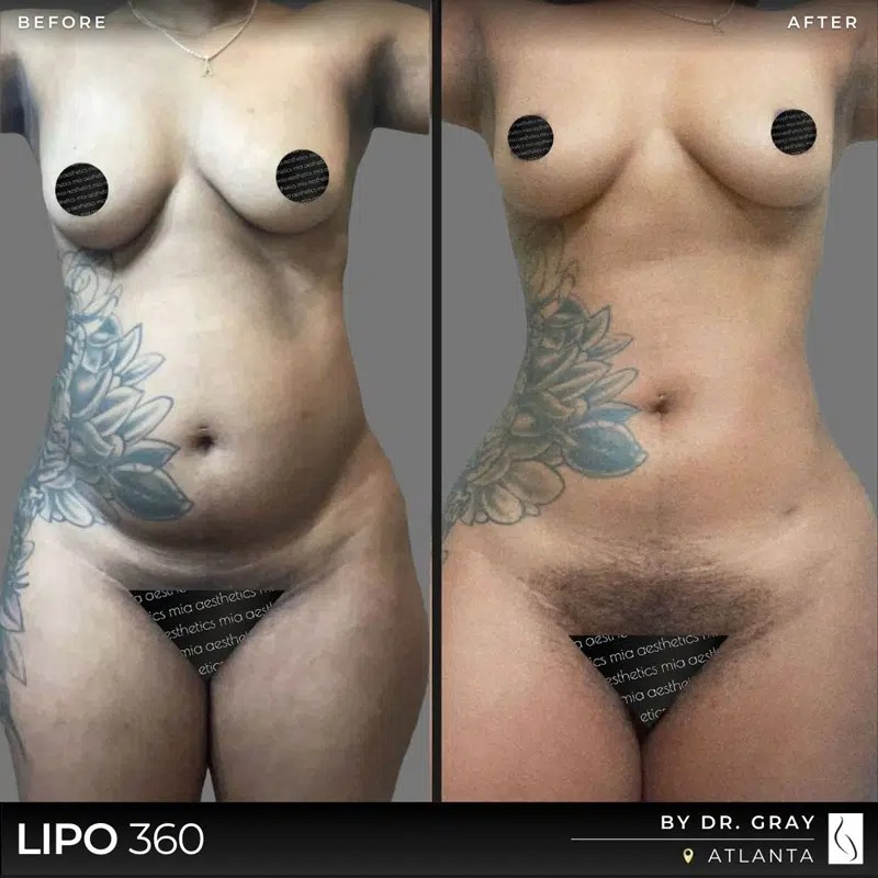 Dr. Gray • Lipo 360 • image 3
