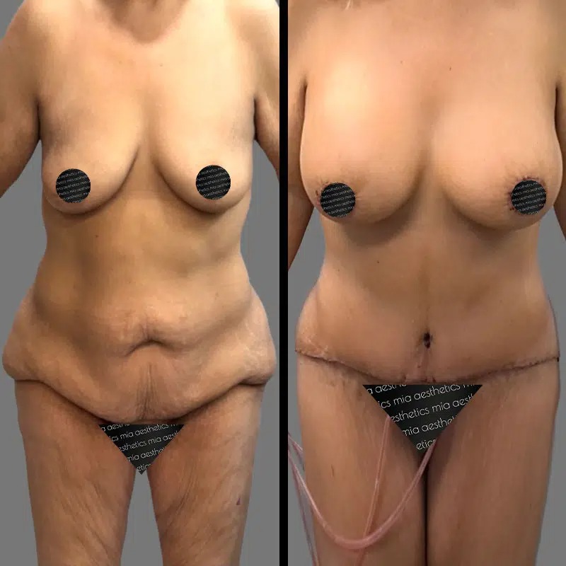 Dr. Gray • Mommy Makeover • image 1