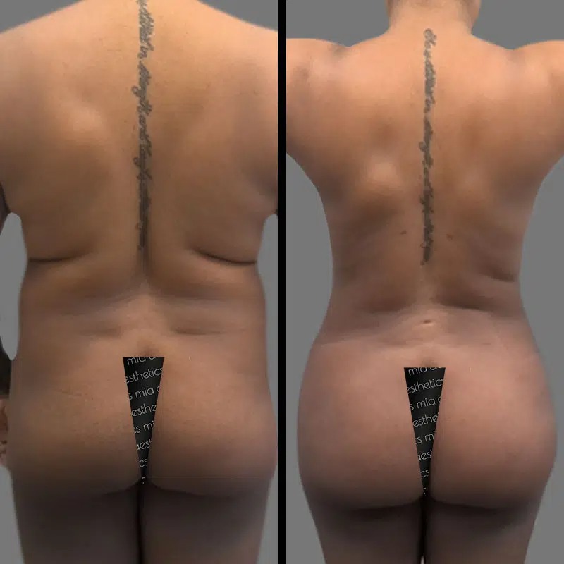 Dr. Gross • Brazilian Butt Lift (BBL) • image 1