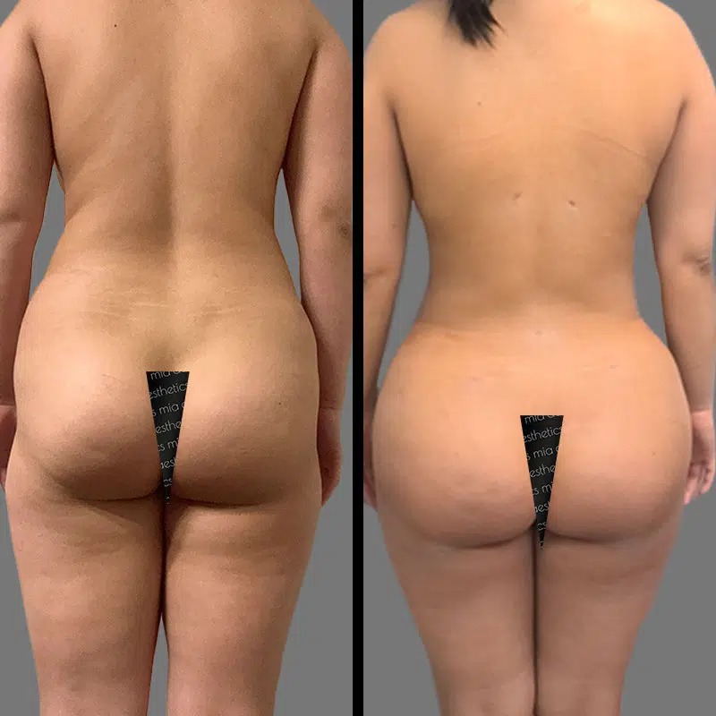 Dr. Gross • Brazilian Butt Lift (BBL) • image 4