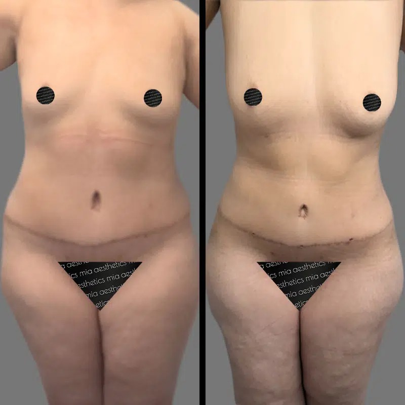 Dr. Gross • Lipo 360 • image 1