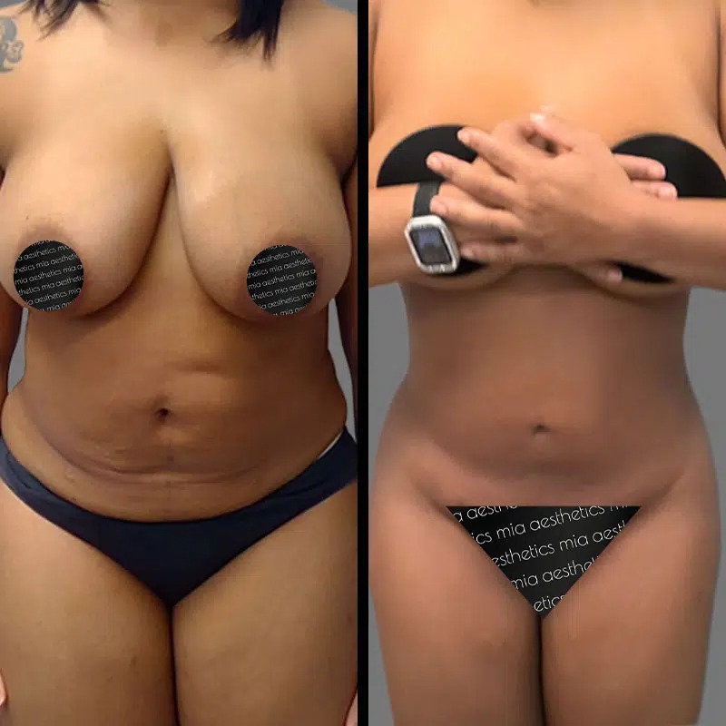 Dr. Gross • Lipo 360 • image 3