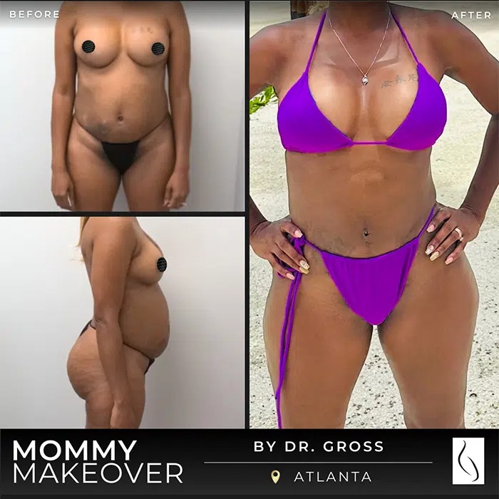 Dr. Gross • Mommy Makeover • image 2