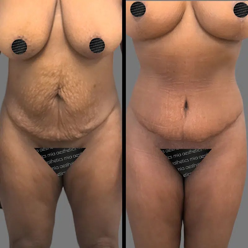 Dr. Gross • Tummy Tuck • image 2