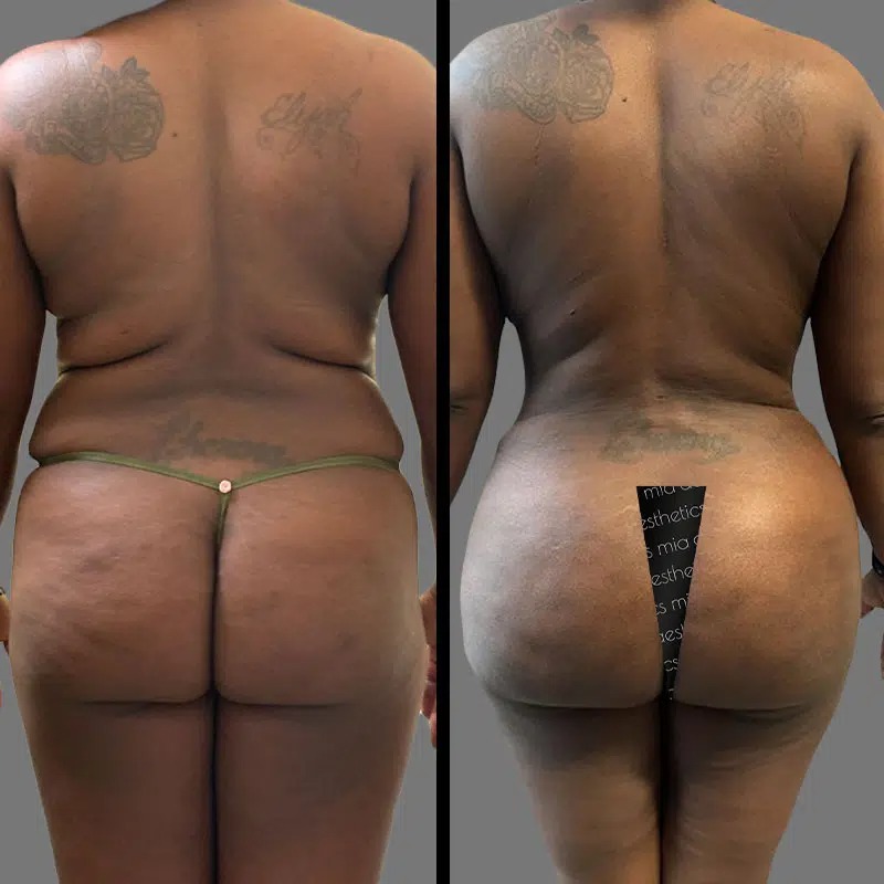 Dr. Horowitz • Brazilian Butt Lift (BBL) • image 3