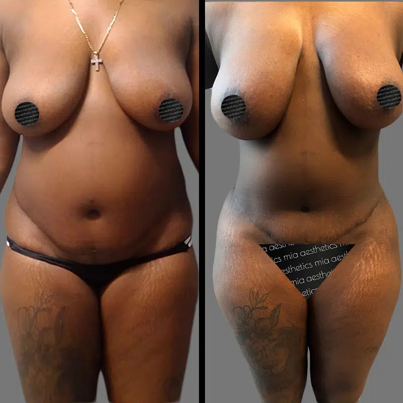 Dr. Horowitz • Lipo 360 • image 2