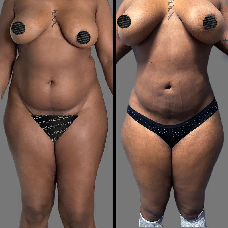 Dr. Horowitz • Lipo 360 • image 3
