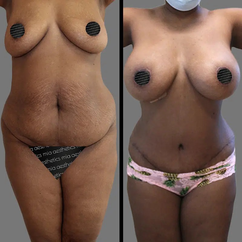Dr. Horowitz • Mommy Makeover • image 4