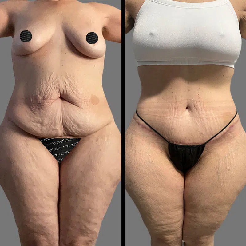 Dr. Horowitz • Tummy Tuck • image 3