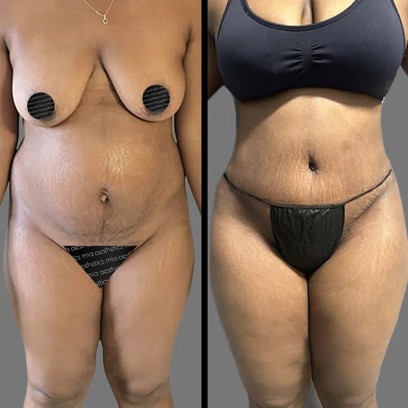 Dr. Horowitz • Tummy Tuck • image 4