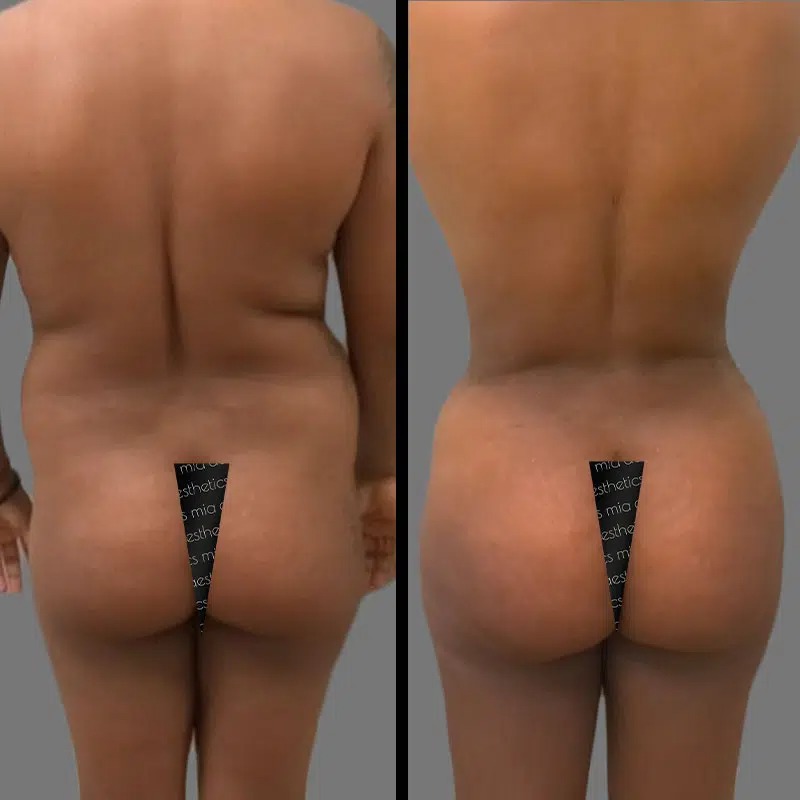 Dr. Kramer • Brazilian Butt Lift (BBL) • image 3