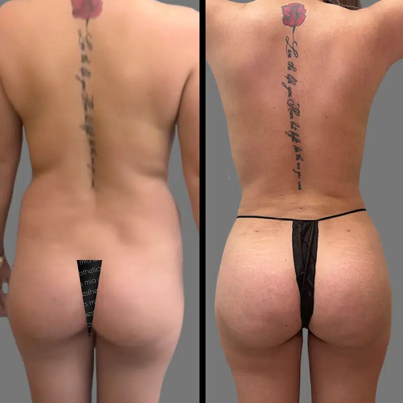 Dr. Kramer • Brazilian Butt Lift (BBL) • image 4