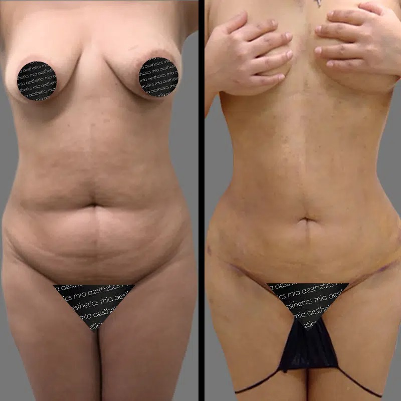 Dr. Kramer • Lipo 360 • image 4