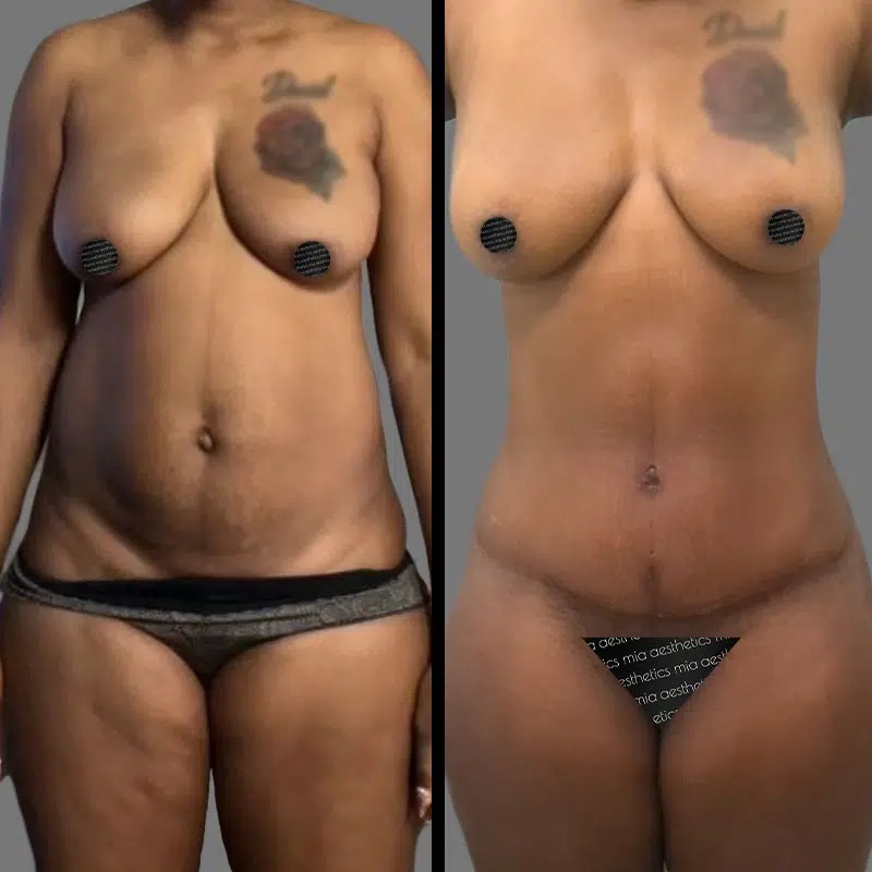 Dr. Kramer • Tummy Tuck • image 4