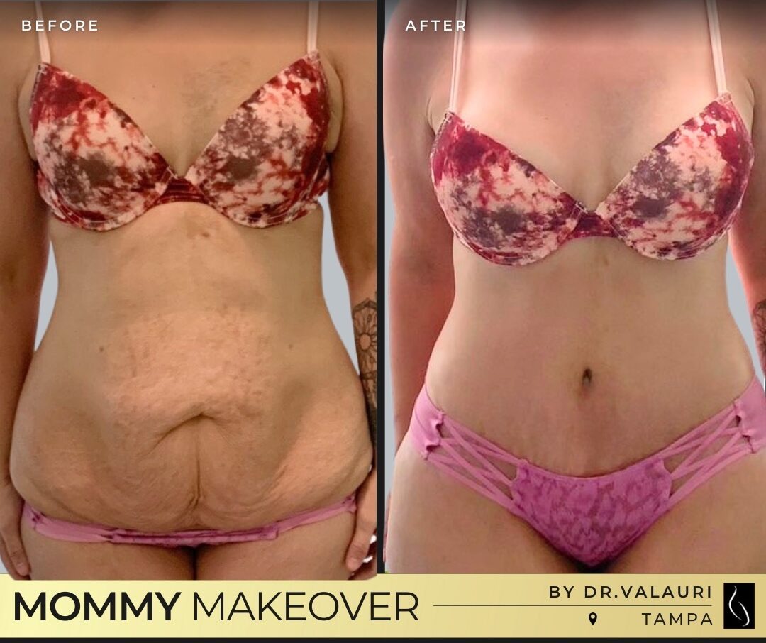 Dr. Kumar • Mommy Makeover • image 1