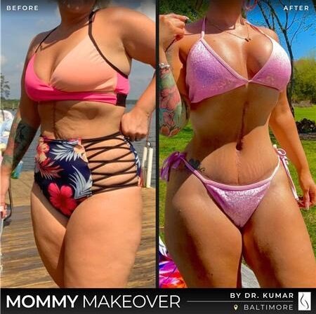 Dr. Kumar • Mommy Makeover • image 2