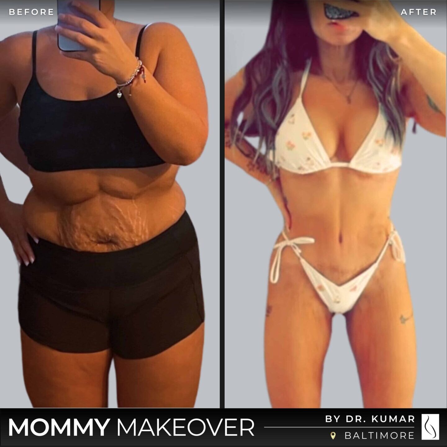 Dr. Kumar • Mommy Makeover • image 5
