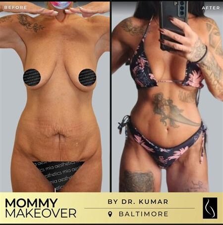 Dr. Kumar • Mommy Makeover • image 3