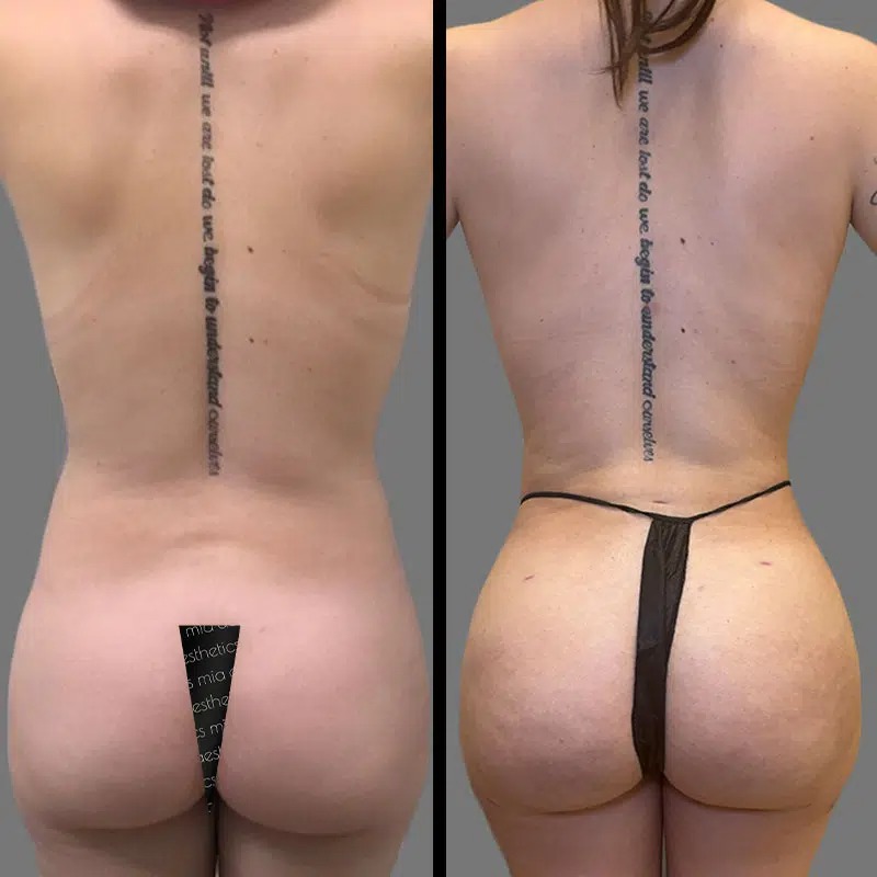 Dr. Kumar • Brazilian Butt Lift (BBL) • image 2