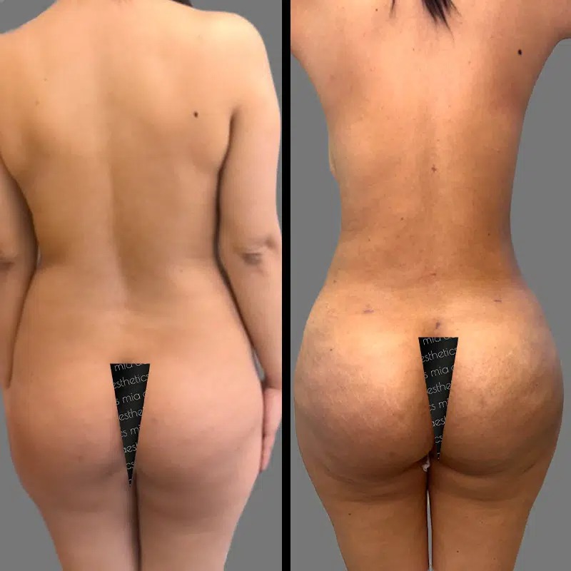 Dr. Kumar • Brazilian Butt Lift (BBL) • image 4