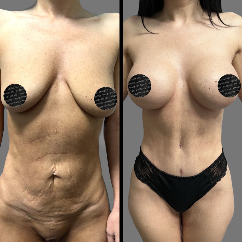 Dr. Mehio • Breast Procedures • image 1