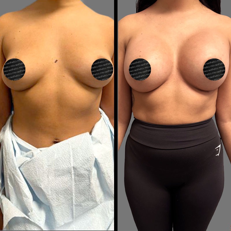 Dr. Mehio • Breast Procedures • image 2