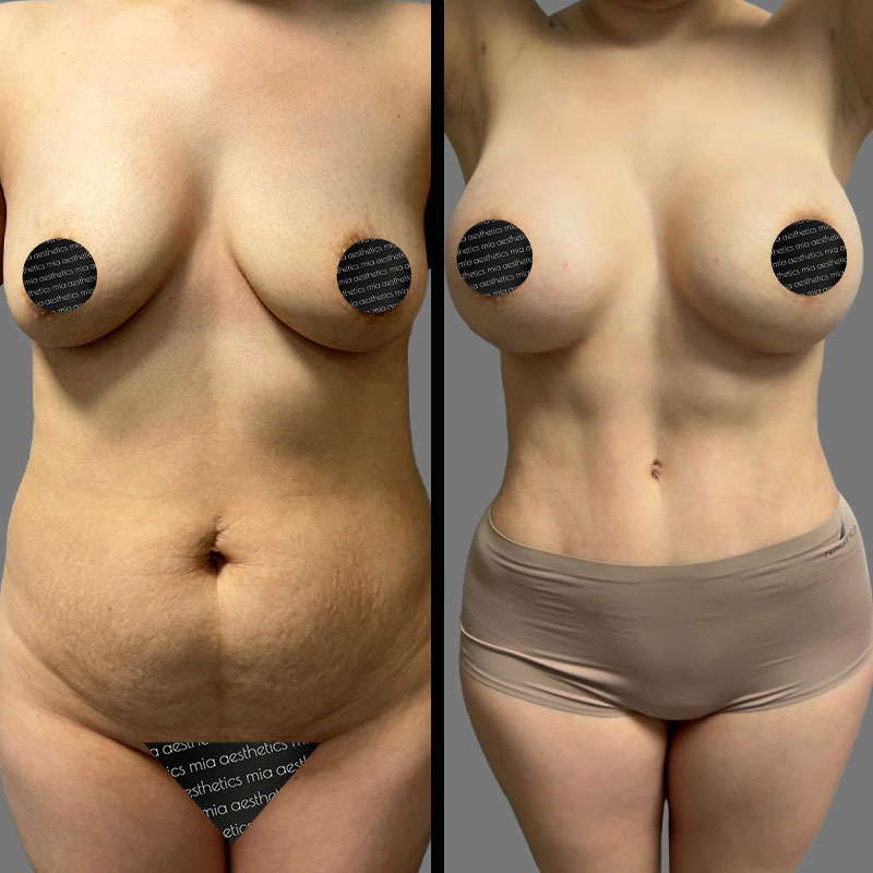 Dr. Mehio • Breast Procedures • image 3