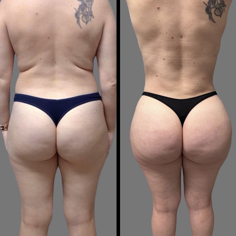 Dr. Mehio • Brazilian Butt Lift (BBL) • image 1