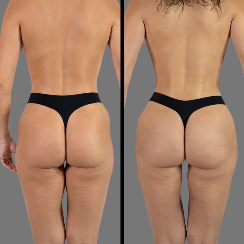 Dr. Mehio • Brazilian Butt Lift (BBL) • image 2
