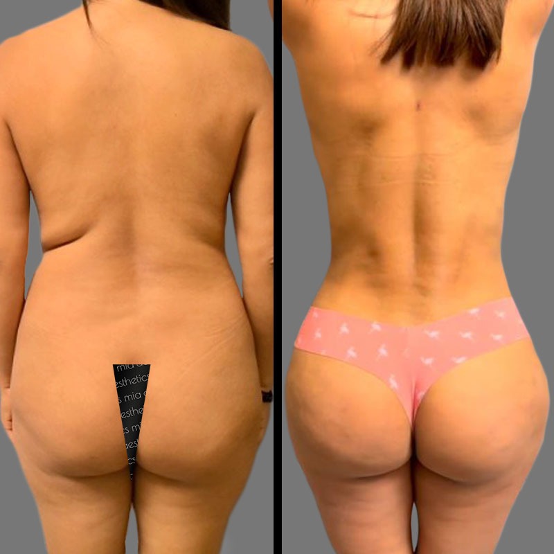 Dr. Mehio • Brazilian Butt Lift (BBL) • image 5